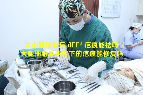 大小腿抽脂后 🌳 疤痕能祛吗（大腿抽脂手术留下的疤痕能修复吗）